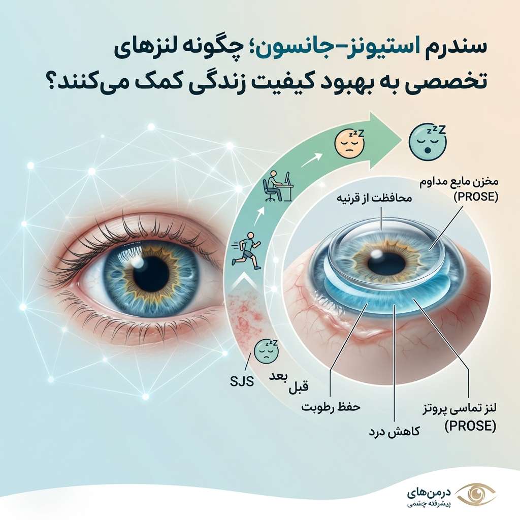 عوارض چشمی سندرم استیونز–جانسون و معجزه لنزهای PROSE در بهبود زندگی